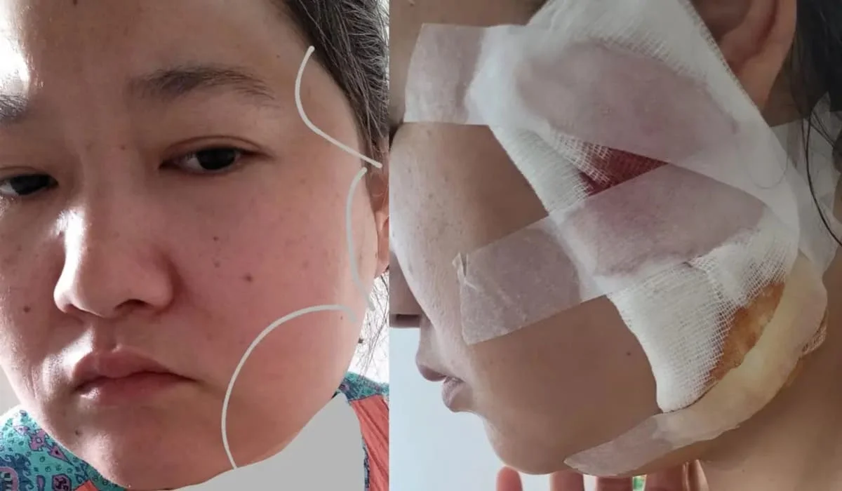 Прокололи щеку: жительница Актау получила осложнения после удаления зуба