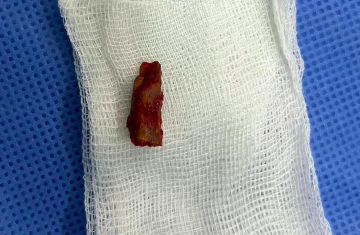 Кусок ветки извлекли из виска ребенка в Павлодаре