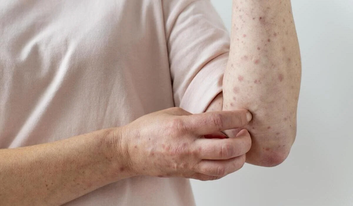 Около 2 тысяч заболевших с начала года: в Казахстане растет заболеваемость корью