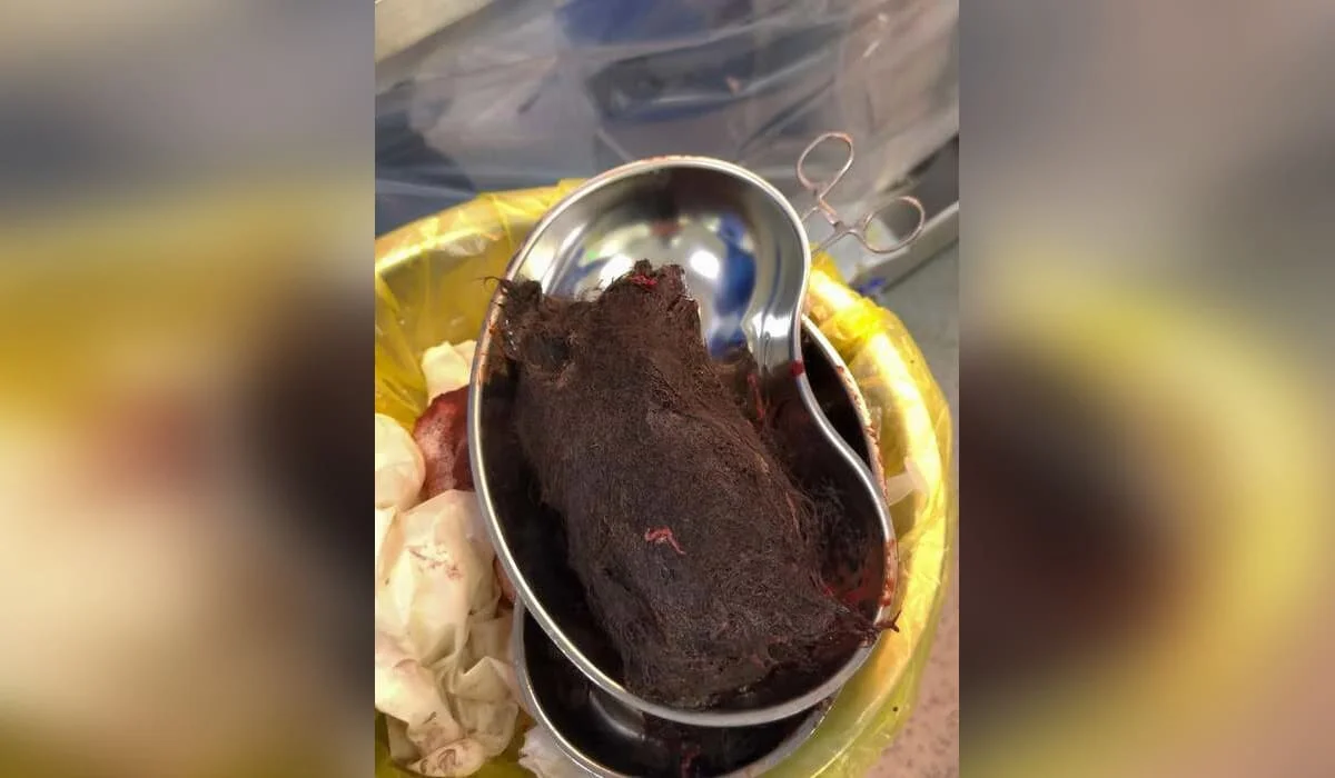 Из желудка девочки извлекли почти килограмм волос в Туркестане