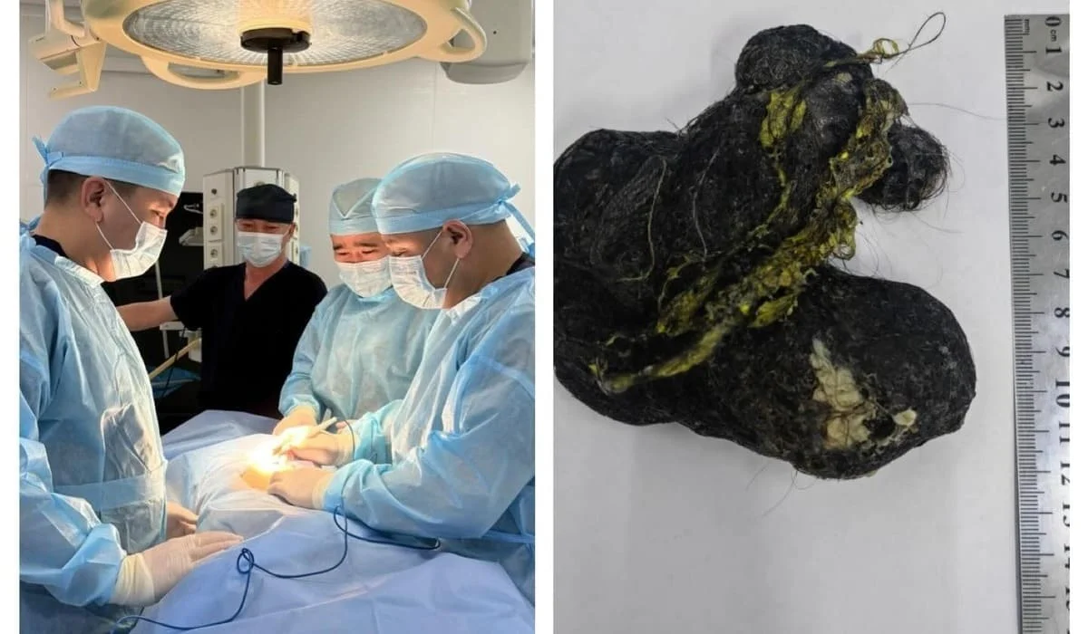 Врачи в Шымкенте достали крупный комок волос из желудка 8-летнего ребенка