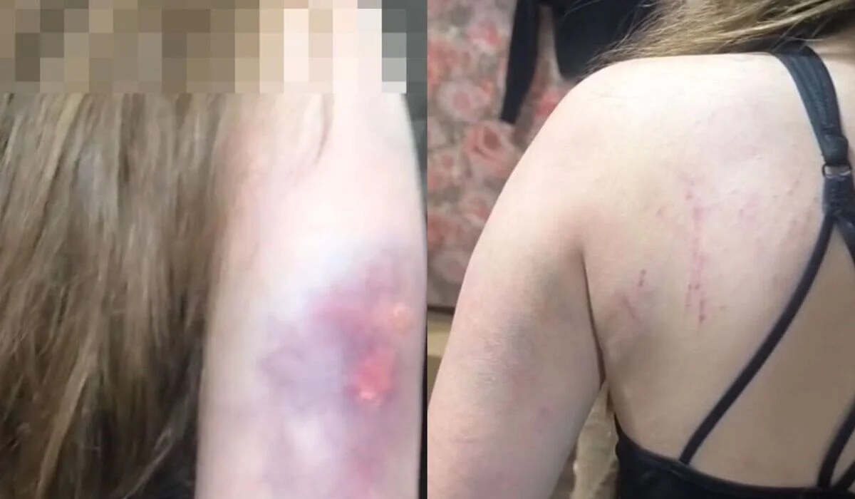 «Снимали на видео и били толпой»: карагандинка добивается справедливости после группового избиения дочери