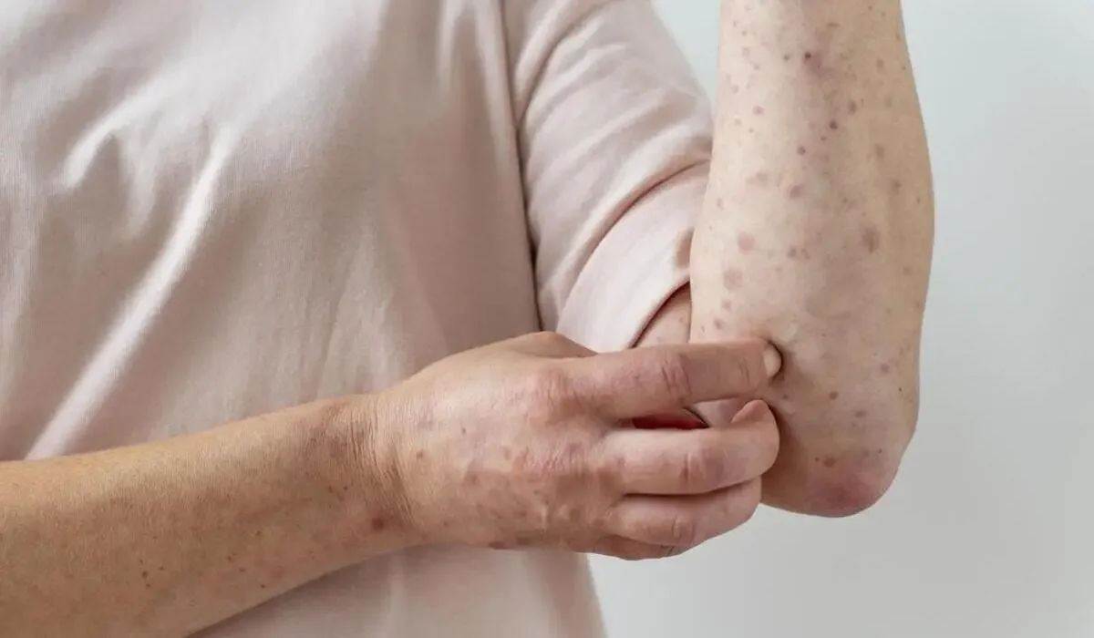 Больше 300 случаев за неделю: где в Казахстане чаще всего болеют корью