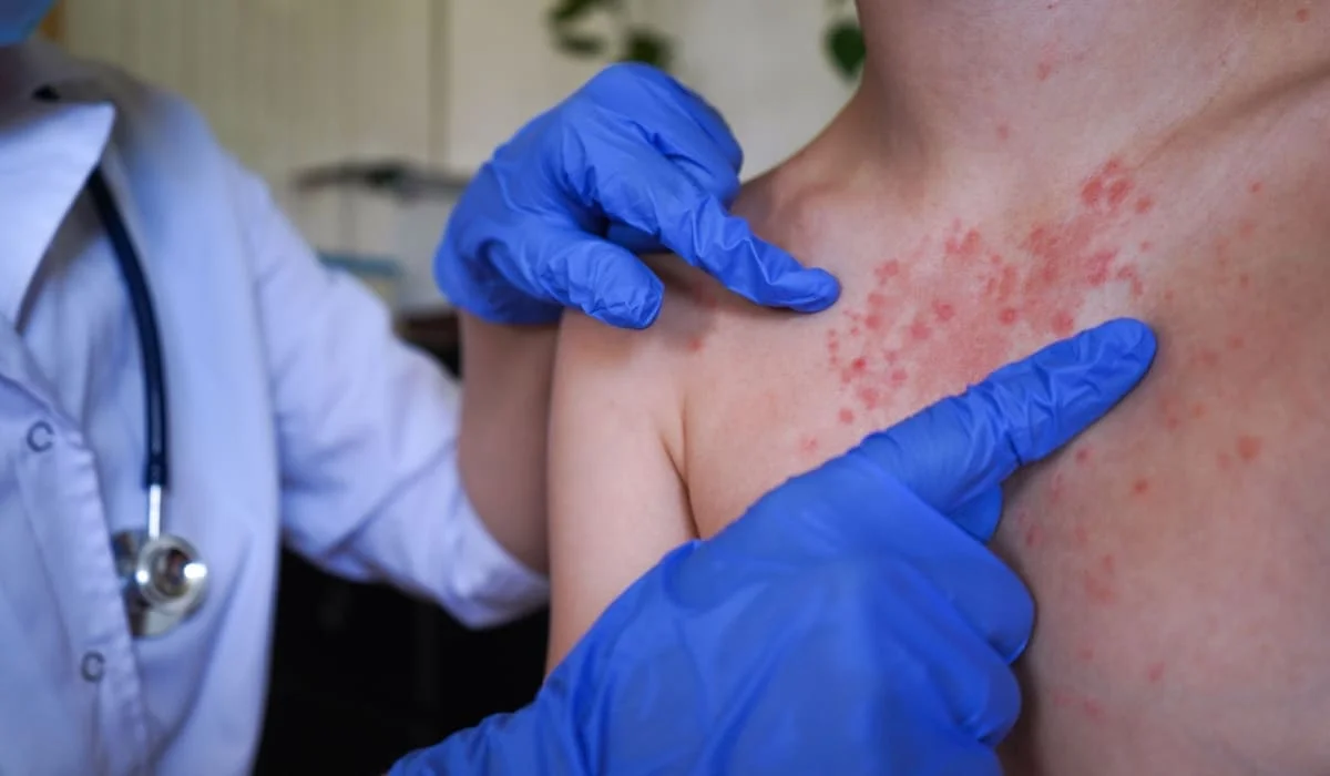 Заболеваемость корью в Казахстане пошла на спад - Минздрав