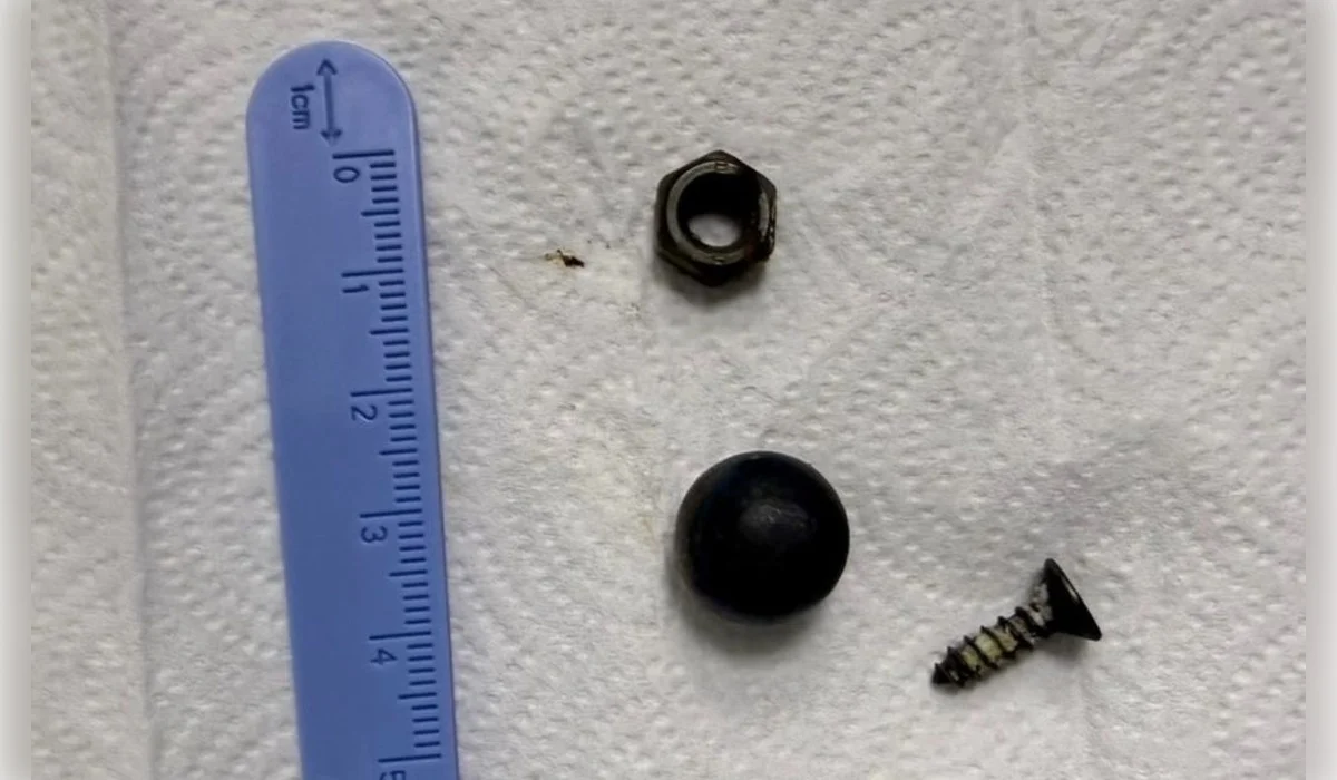 Хирурги извлекли из кишечника 6-летнего ребенка магнит, винт и гайку в Шымкенте