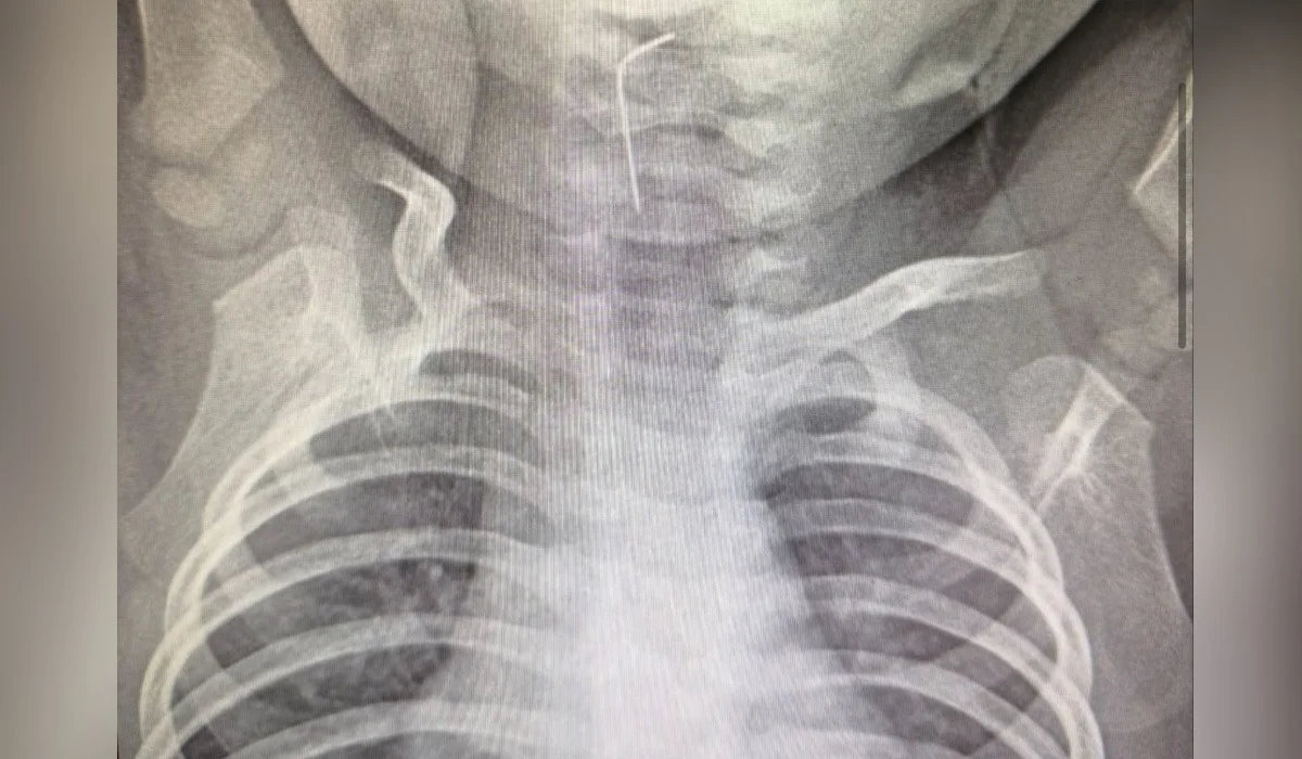 Девятимесячный малыш проглотил иглу в Туркестанской области