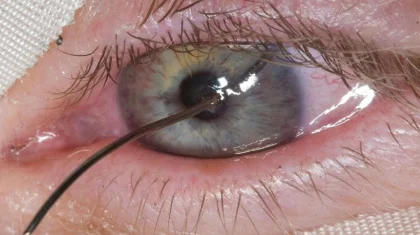 Проволока воткнулась в глаз алматинца