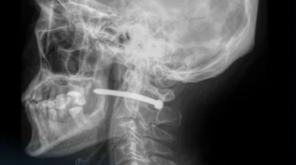 Гвоздь едва не убил мужчину в Петропавловске – спасли считанные миллиметры