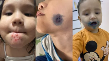 Новый вирус вызывает сыпь у детей? В Минздраве ответили на опасения родителей