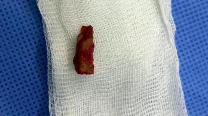 Кусок ветки извлекли из виска ребенка в Павлодаре