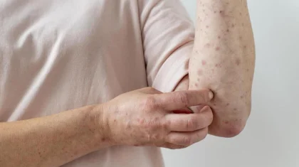 Около 2 тысяч заболевших с начала года: в Казахстане растет заболеваемость корью