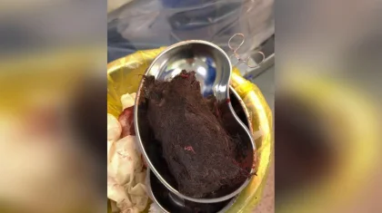 Из желудка девочки извлекли почти килограмм волос в Туркестане