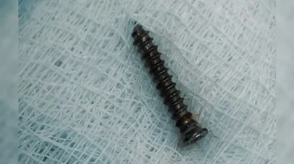 Врачи достали шуруп из желудка ребенка в Павлодаре (ВИДЕО)