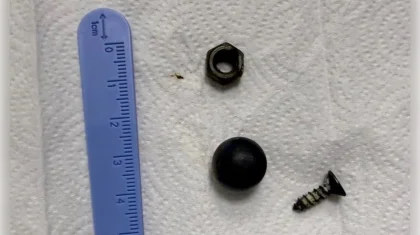 Хирурги извлекли из кишечника 6-летнего ребенка магнит, винт и гайку в Шымкенте