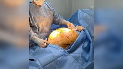 Пациентке в Алматы удалили гигантскую 25-килограммовую опухоль